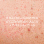 home remedies for itching pubic area after shaving